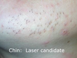 Chin laser candidate