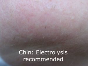 electrolysis recommended