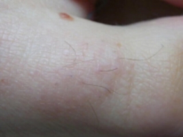 Toe 6 months after 2 laser treatments