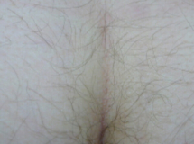 Buttocks 4 months after 1 laser treatment