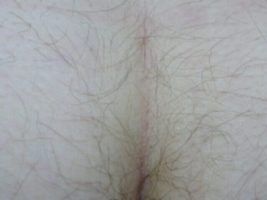 Buttocks 4 months after 1 laser treatment