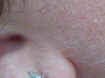 Female Sideburns 1 year after 2 laser treatments