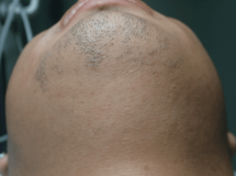 Type 4 Male Beard 1 year after 5 laser treatments