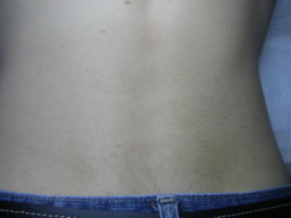 Male Lower Back 1 year after 2 laser treatments