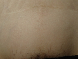 Upper Bikini 11 years after 7 laser treatments
