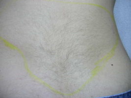 Male Lower Back Before