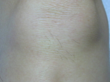 Knee 8 months after 3 laser treatments