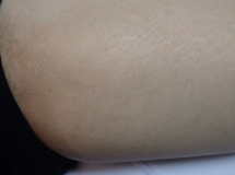 Thigh 15 months after 7 laser treatments