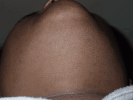 Type 5 skin 1 year after 7 laser treatments