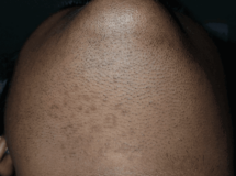 Type 5 skin before laser treatment