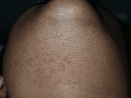 Type 5 skin before laser treatment