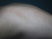 Male Back 6 months after 6 laser treatments