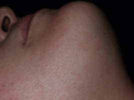 Female Chin 11 months after 6 laser treatments