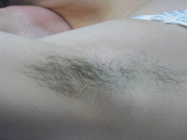 Underarm Before